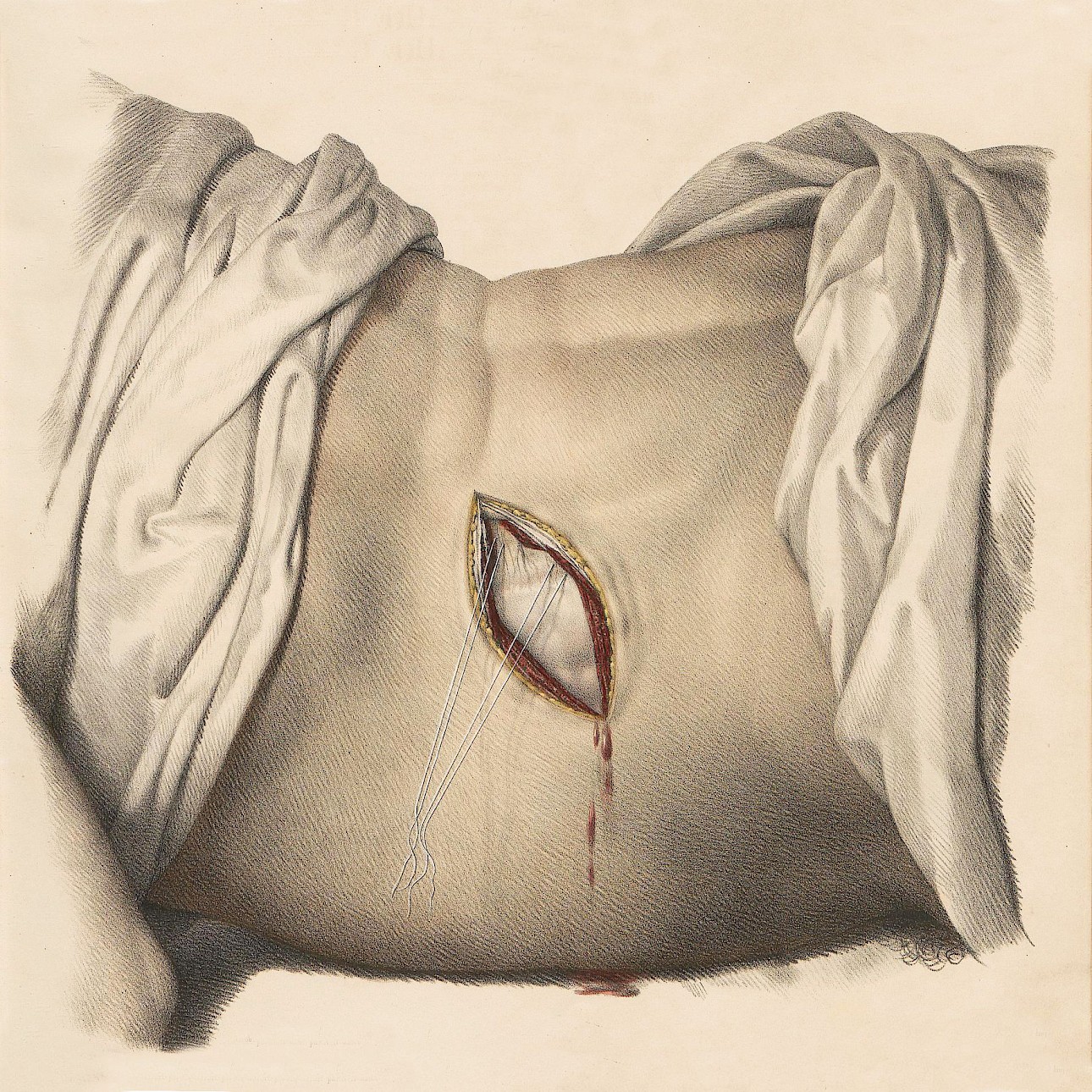 ALKANARA - Grande plano de uma ferida cosida num abdómen nu, com fios e sangue, parcialmente coberta por um tecido branco. - ©“Anus artificial lombar esquerdo”, pormenor, em Jean Baptiste Marc Bourgery e Nicolas Henri Jacob (litografias), ‘Traité complet de l'anatomie de l'homme: comprenant la medicine opératoire’, Paris, C. Delaunay, vol. 7, ‘Atlas’, 1840, pl. 42.